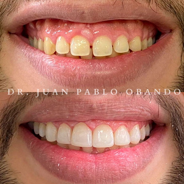 Est Tica Dental En Santiago Mejora Tu Sonrisa Con Tratamientos Cosm Ticos