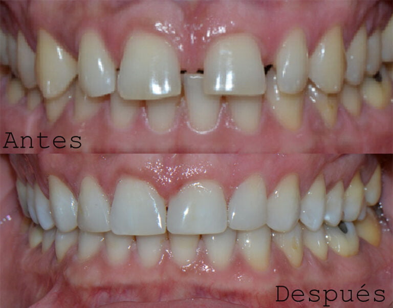 Ortodoncia con Brackets, Frenillos o Alineadores DentArt Clinica de