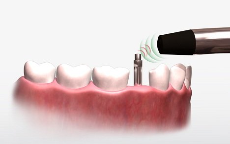 Osstell e Implanes dentales