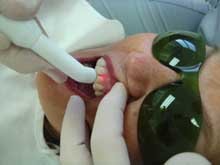 Tratamiento dental laser