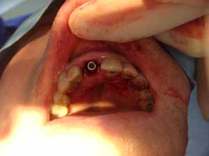 Vista oclusal del implante dental con su pilar