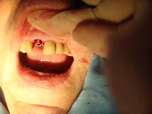 implante dental 13 mm de longitud
