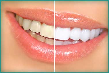 Antes y Despues Blanqueamiento Dental