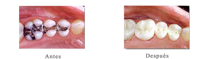 Antes y Despues amalgamas carillas