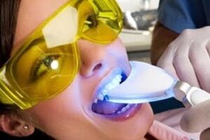 blanqueamiento dental Zoom