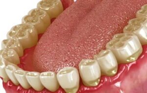 Bruxismo - Causas y tratamiento de apretar los dientes - Clínica Pardiñas