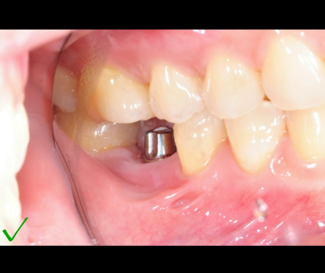 Ventajas de los Implantes Dentales
