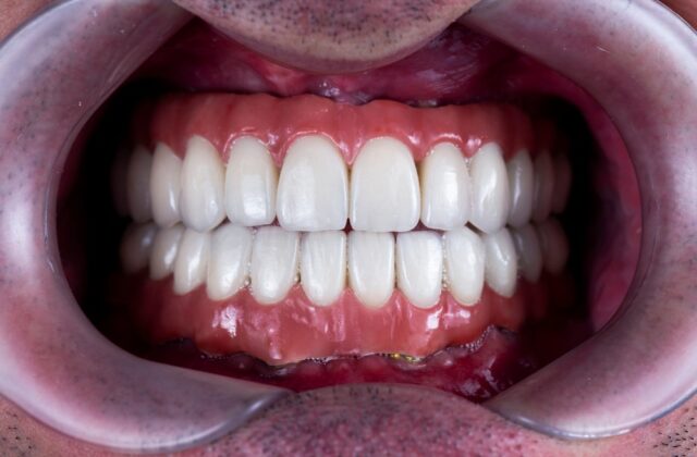 solución con implantes dentales - dentart 2